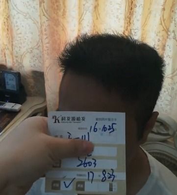 拯救高发际线，这些方法让你重拾自信！ 1