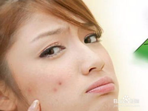 如何快速去除痘印? 1